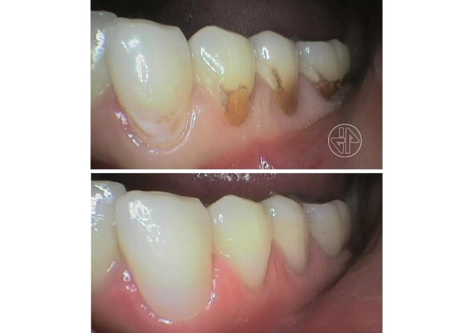 Abfracción Dental - Imagen 2