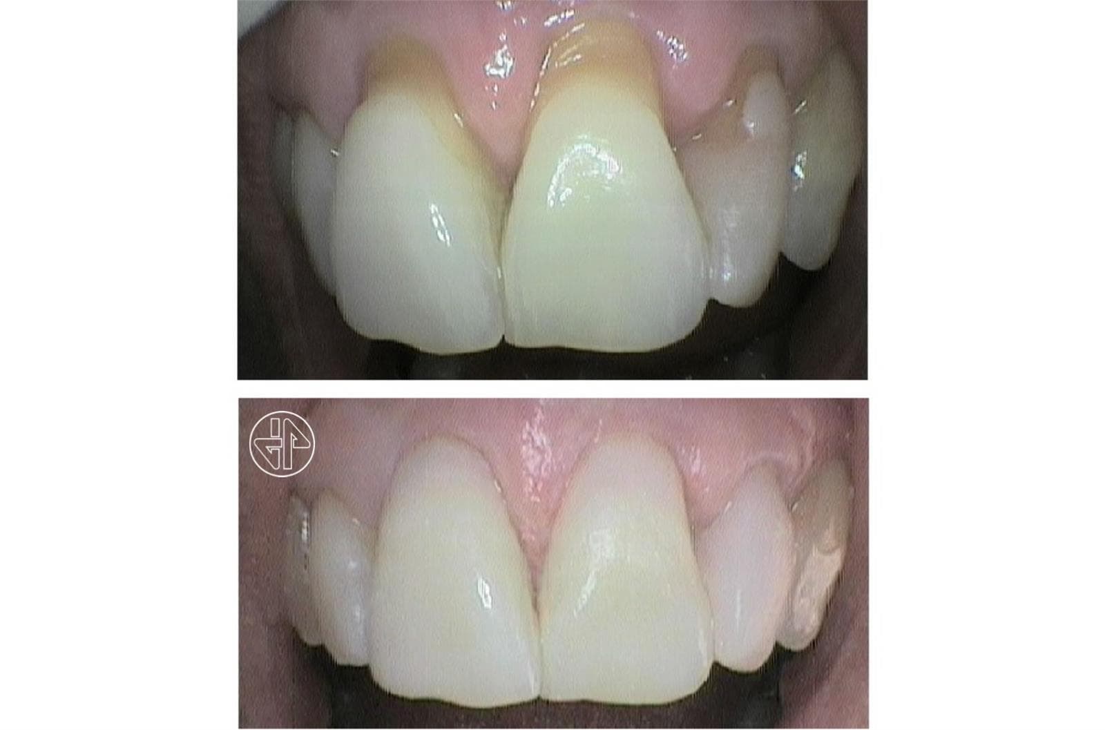 Abfracción Dental - Imagen 3