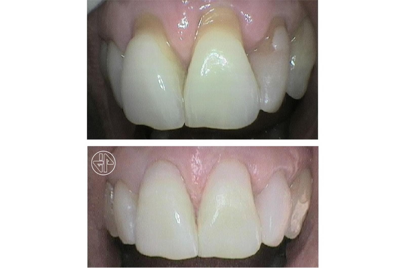 Abfracción Dental - Imagen 3