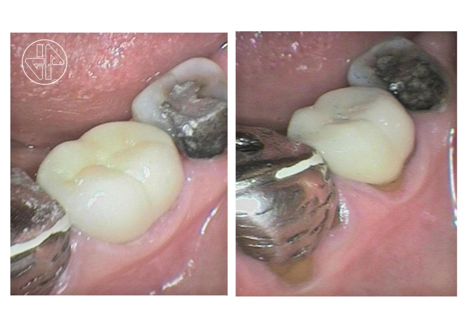 Abfracción Dental - Imagen 5