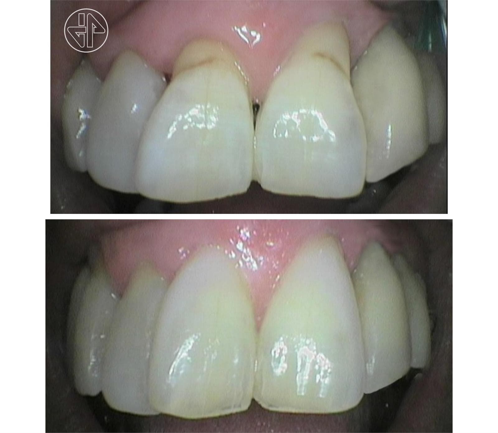 Abfracción Dental - Imagen 4