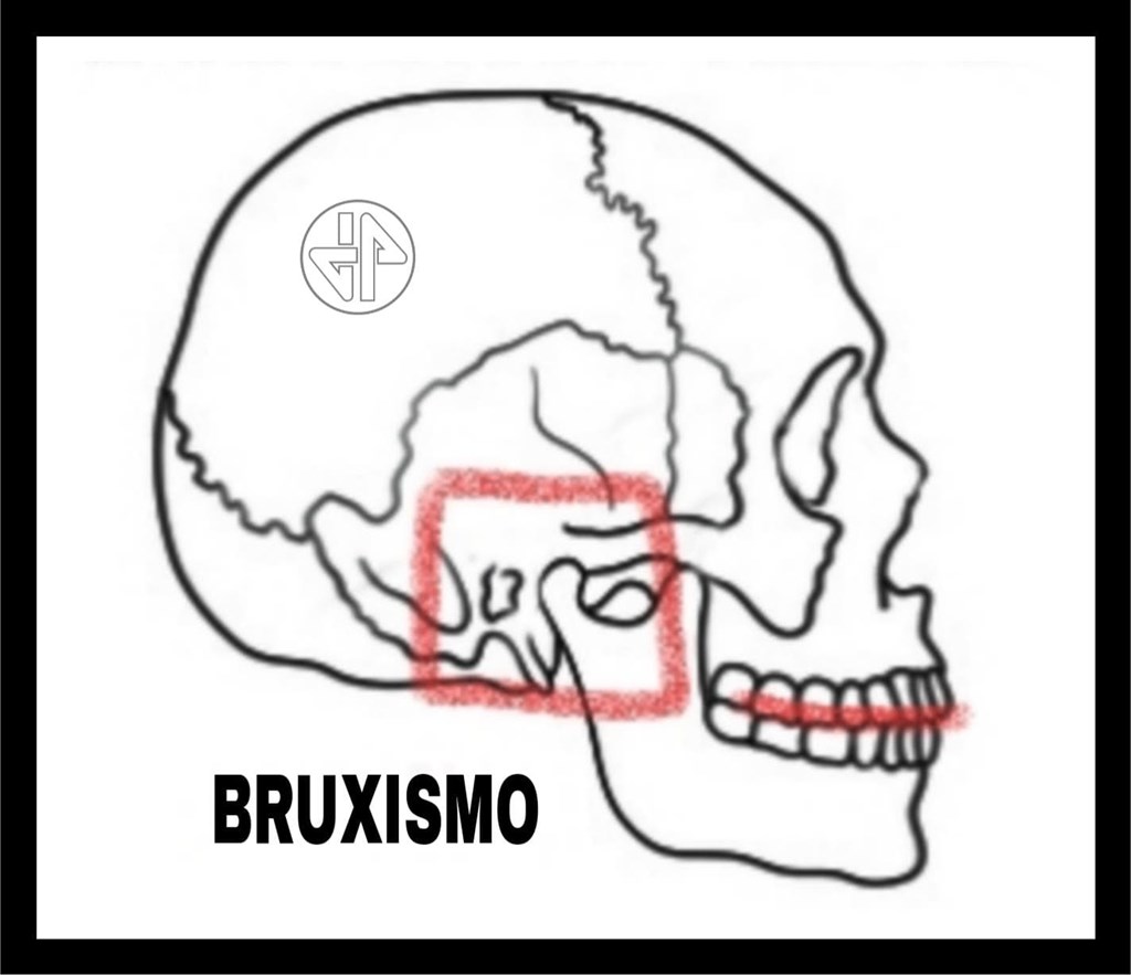 BRUXISMO