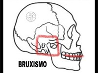BRUXISMO