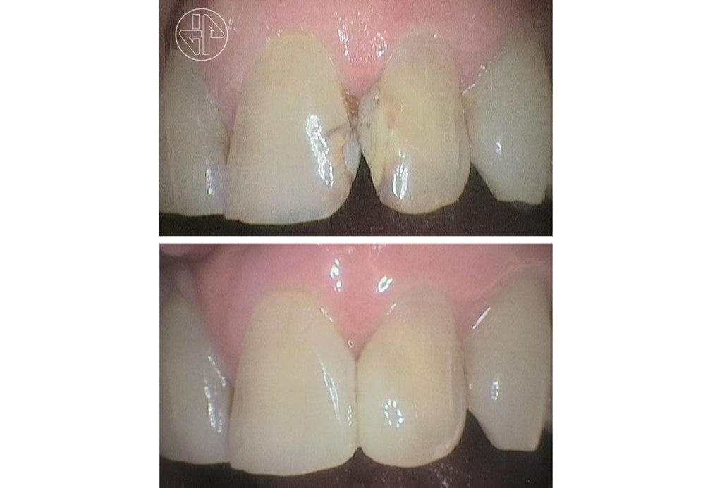 Cambio de antigua restauración dental.