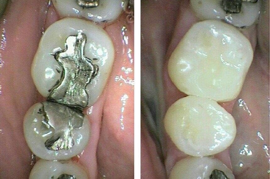 Cambio de antigua restauración dental. - Imagen 2