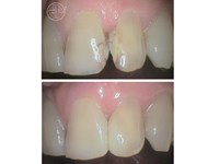 Cambio de antigua restauración dental.