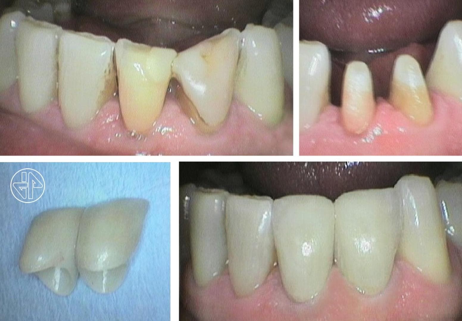 Coronas de Zirconio. - Imagen 10