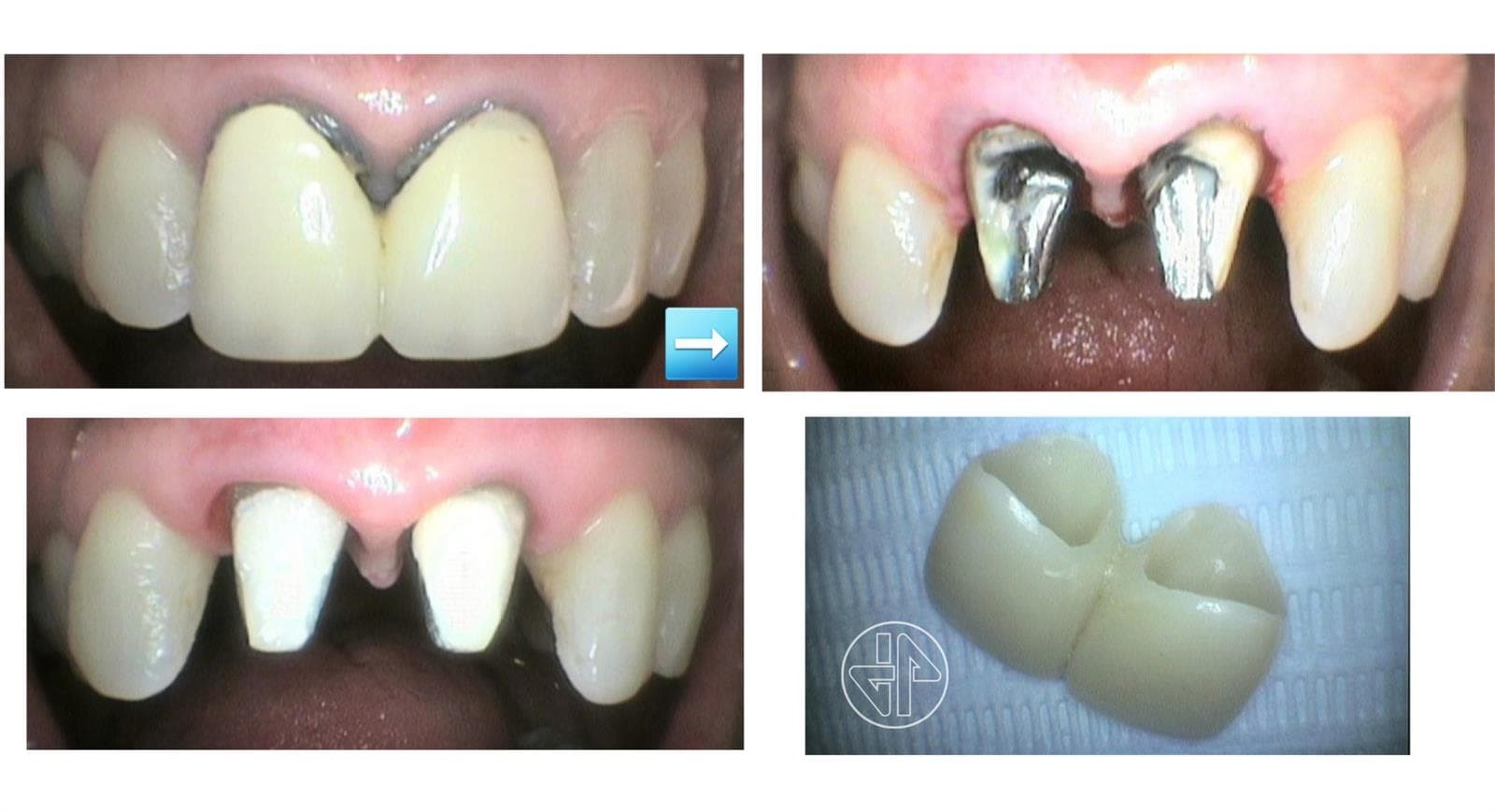 Coronas de Zirconio. - Imagen 5