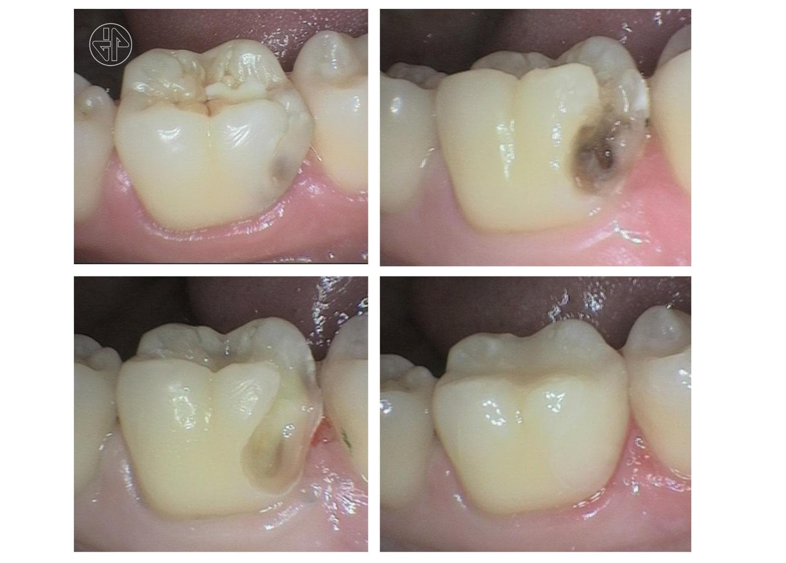 Evaluación de las Restauraciones dentales. - Imagen 7