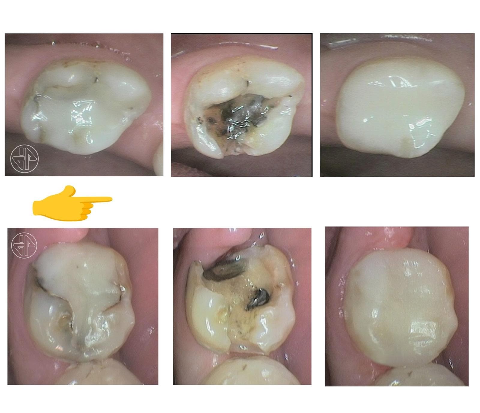 Evaluación de las Restauraciones dentales. - Imagen 10