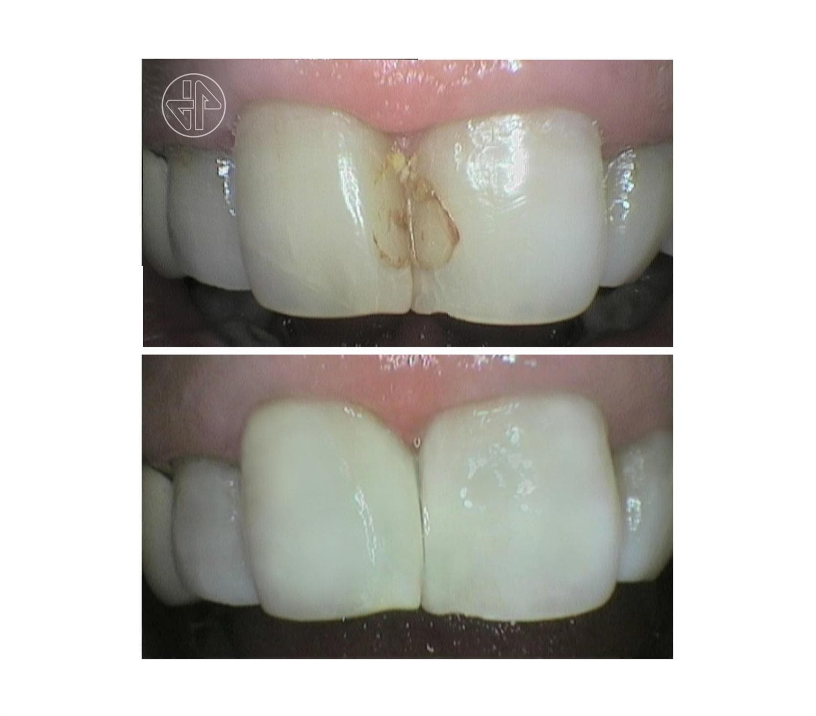 Evaluación de las Restauraciones dentales. - Imagen 11