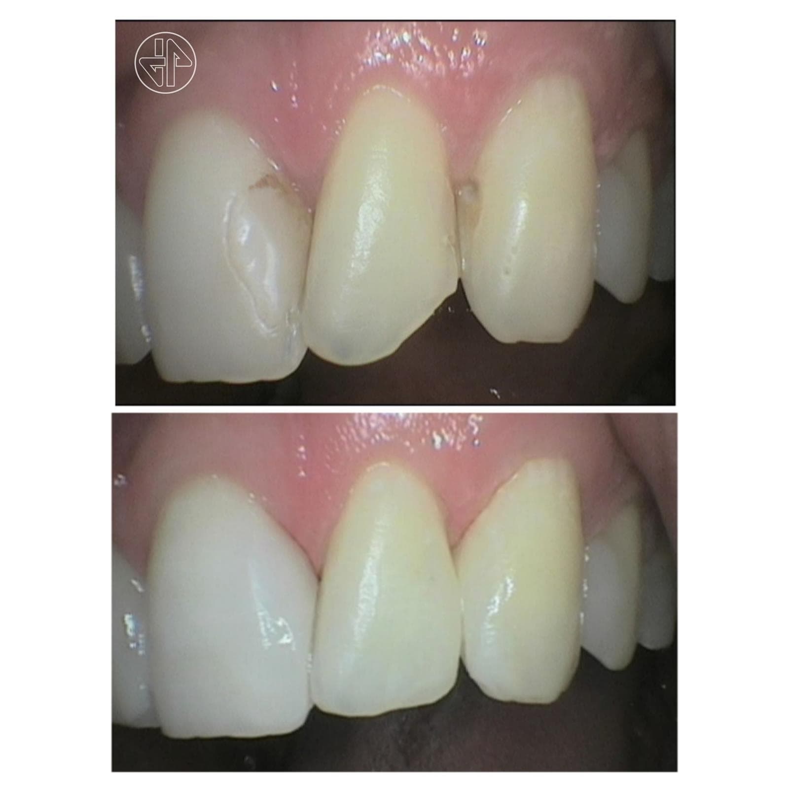 Evaluación de las Restauraciones dentales. - Imagen 13