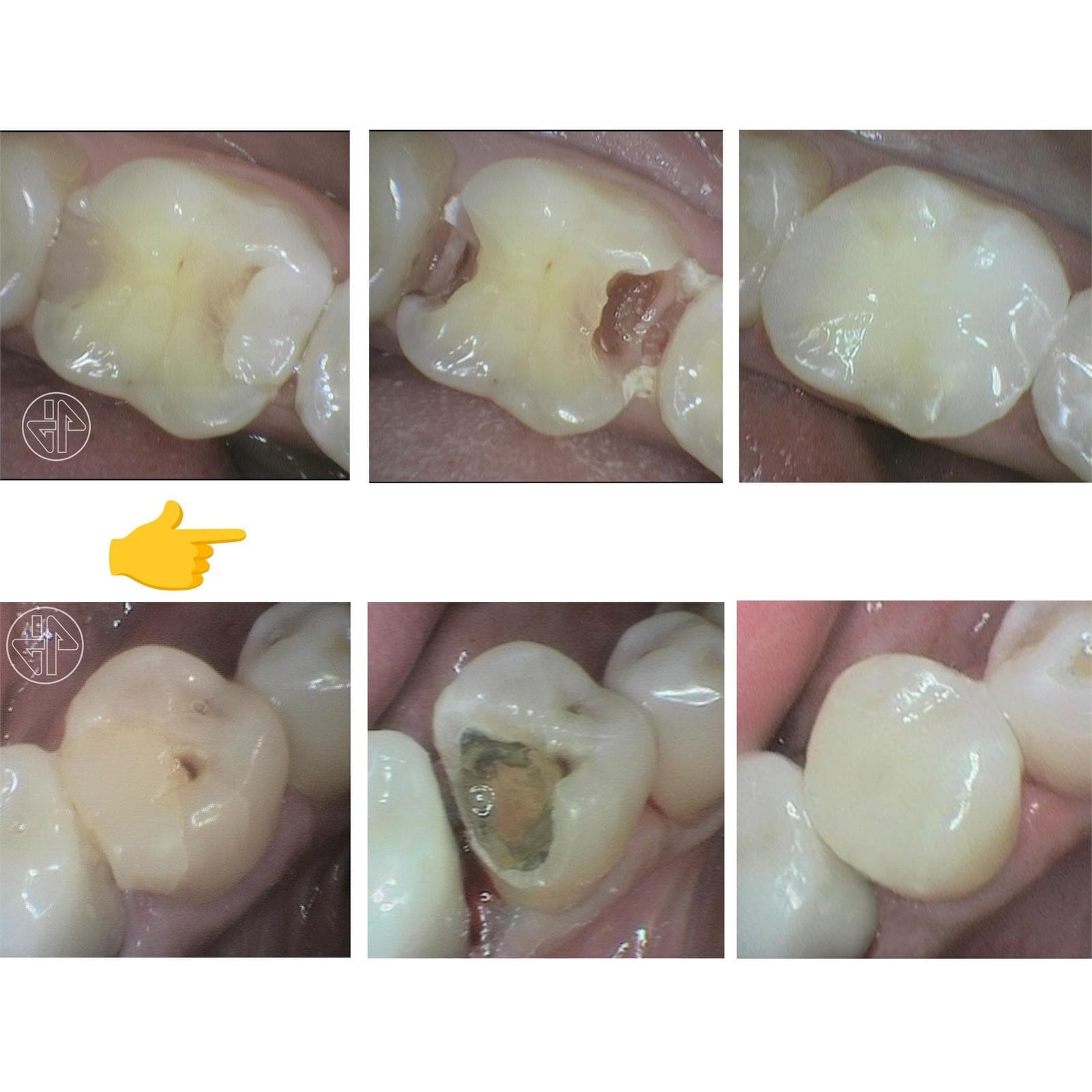 Evaluación de las Restauraciones dentales. - Imagen 9