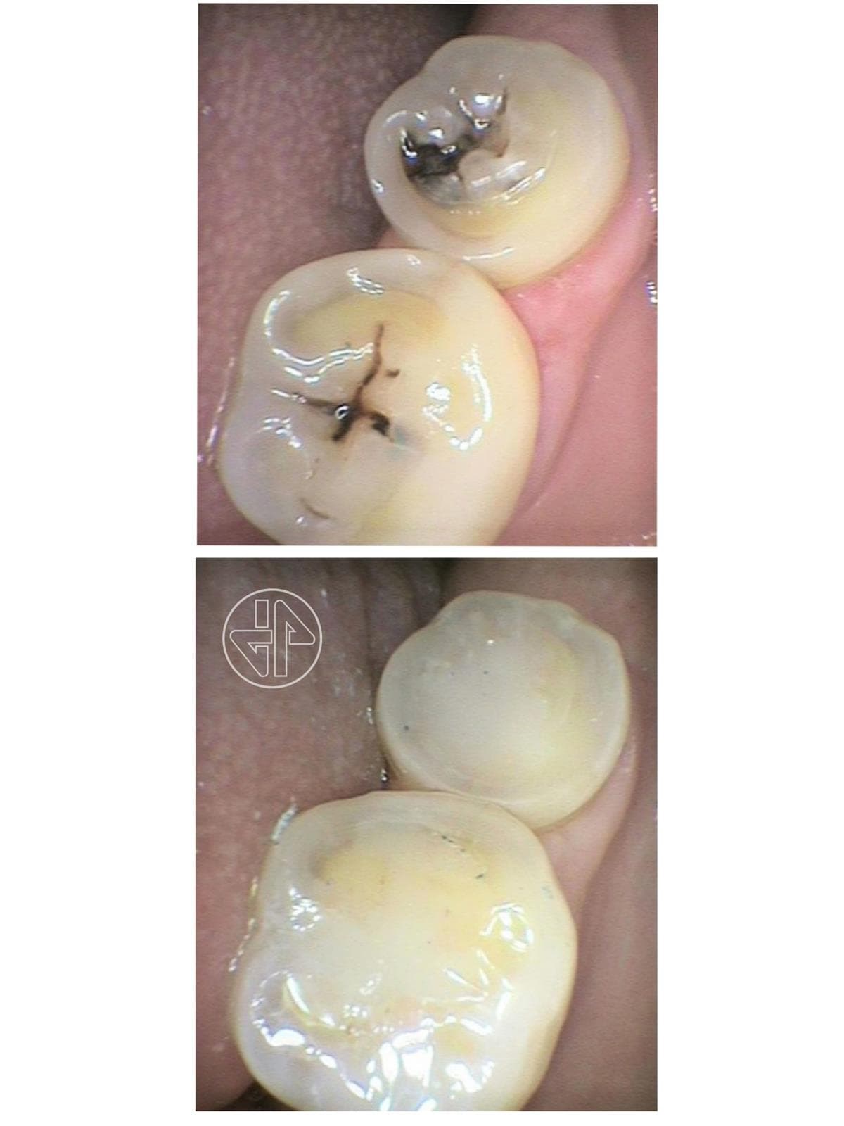 Sellante Dental  - Imagen 4