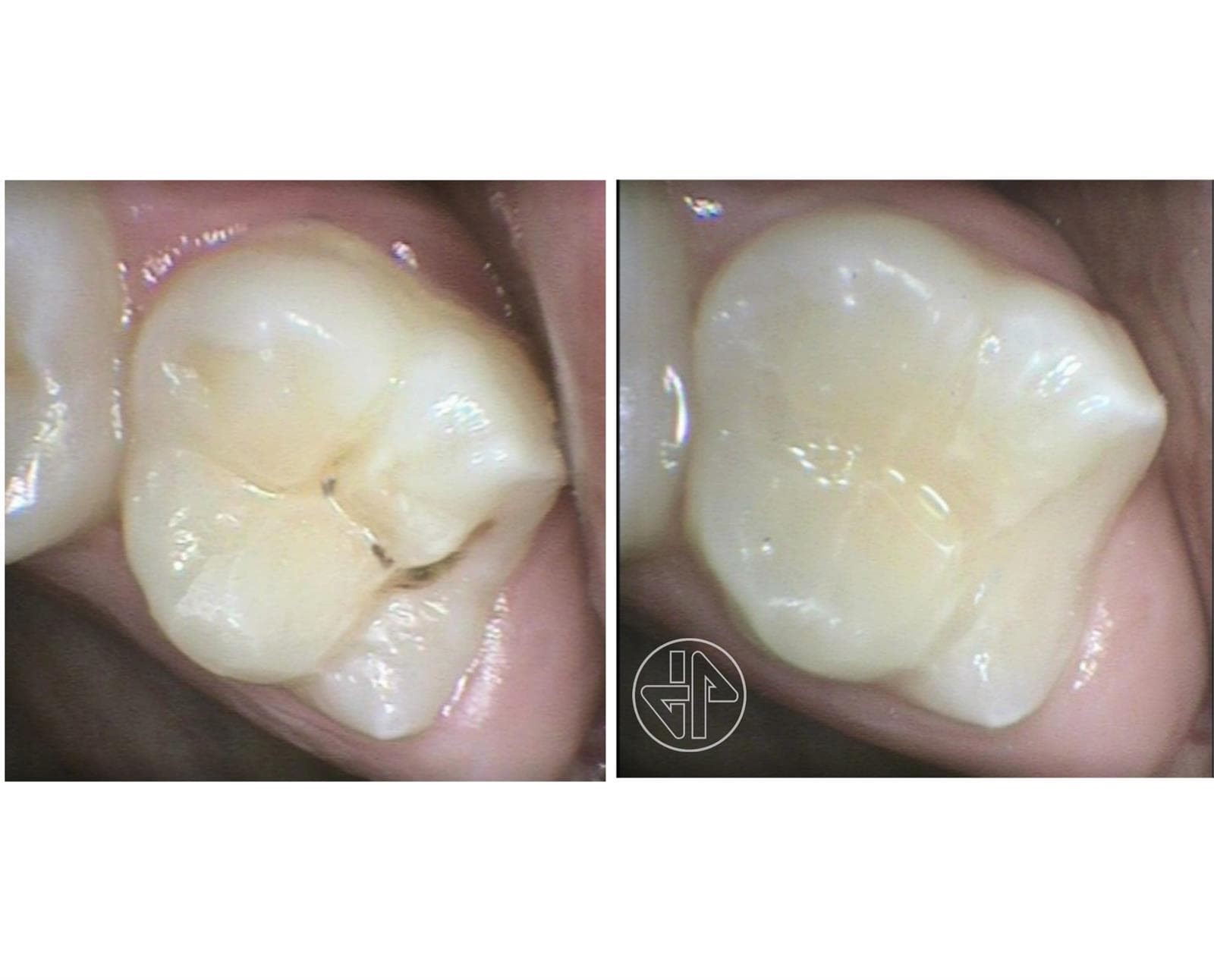 Sellante Dental  - Imagen 1